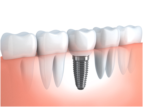 dental implants treatment | Tower House Dental Clinic