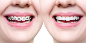 best invisalign dentist in Agoura Hills