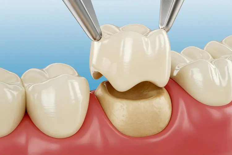 dental crown
