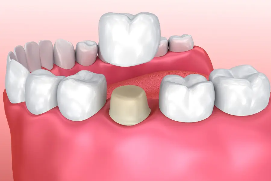 dental crown in Agoura Hills