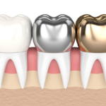 porcelain-dental-crowns